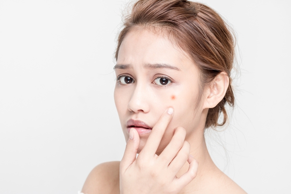 痘印怎么去除最有效的方法
