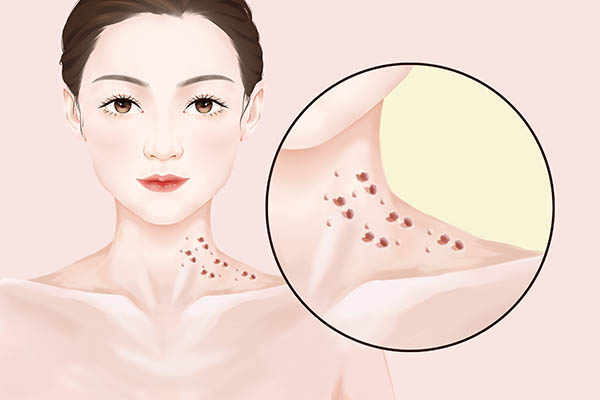 HPV66阳性的最坏结果是什么